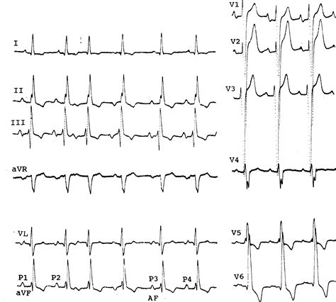 房性并行心律的心电图RR序列及心电散点图特征 - 心血管 - 天山医学院
