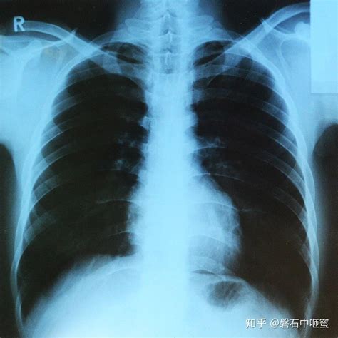 最近说诊断新型肺炎，必须要拍片，那拍片用的X光是核辐射吗？ - 知乎