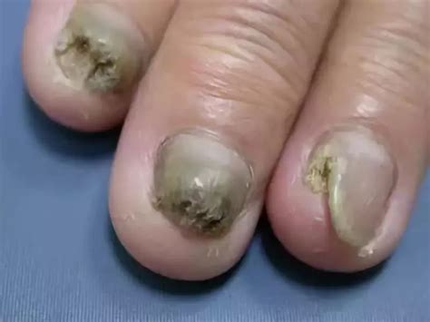 灰指甲是什么原因造成的？