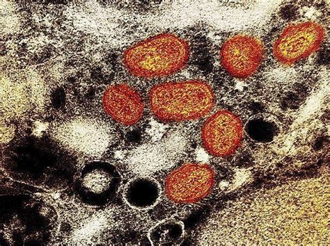 实时报道 | 巴西和西班牙出现首例猴痘死亡病例（2022北京国际生命健康博览会特别报道） - 知乎