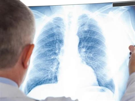 指南：热消融治疗肺部亚实性结节专家共识（2021年版）_医学界-助力医生临床决策和职业成长