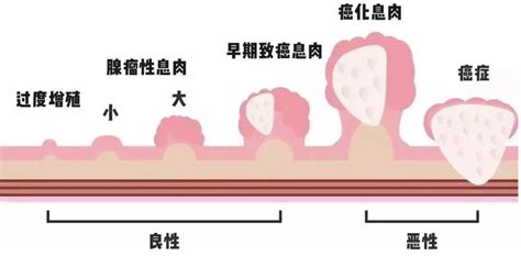 图解：不同类型肠息肉，内镜下切除术-MedSci.cn