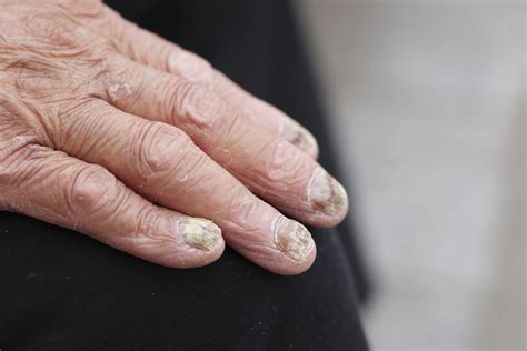 灰指甲的初期症状-灰指甲症状-复禾健康