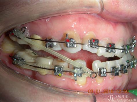 三岁乳牙反合偏颌，后牙正锁颌的矫正-海边牙医廖的博客-KQ88口腔博客