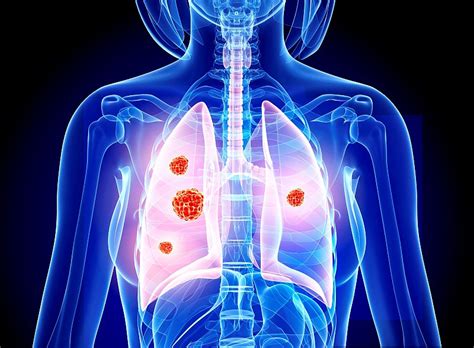 肺癌治疗新突破，免疫治疗PD-L1抑制剂大大提升疗效|免疫治疗|肺癌|肿瘤|-健康界
