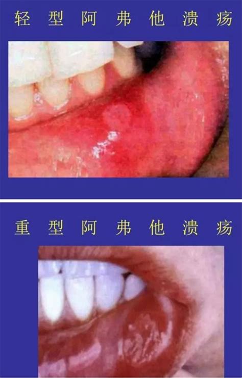 口腔上颚溃疡图片