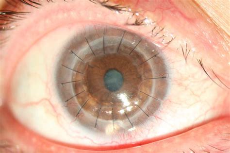 穿透性角膜移植术联合青光眼小梁切除术-眼科手术-医学