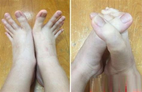女大学生“脚趾长成了手”，被人称“稀有动物”，网友：用着真棒|脚趾|女大学生|脚趾头_新浪新闻