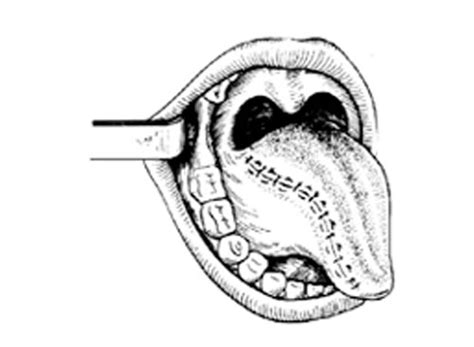 半舌切除术过程图解-手术图解,_医学图库