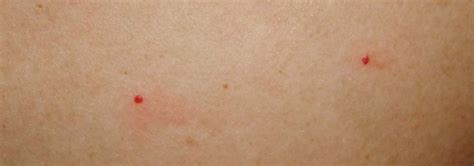 艾滋病初期小红点照片，特征和斑丘疹/玫瑰丘疹相同(不痒不痛) — 神奇养生网