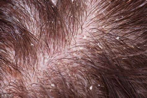 皮肤有毛囊炎怎么治（去毛囊炎的几个小方法，不要毛囊炎的病情再次发生） | 说明书网