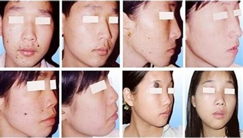 正常痣的样子图片