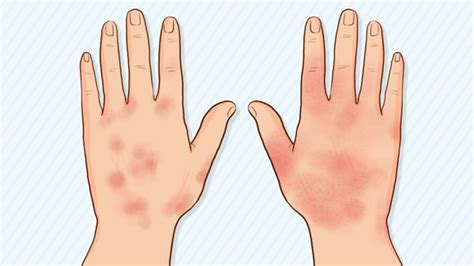 中华医学会 科普图文 湿疹的三种典型症状，你都知道吗？