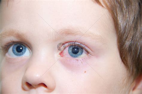 儿童眼结膜炎眼科疾病红眼睛血管在眼中爆高清图片下载-正版图片506223110-摄图网