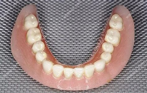 满口假牙哪种比较舒服?吸附性义齿/纯钛/钛合金假牙材质好 - 口腔资讯 - 牙齿矫正网