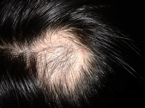 秃头的前兆是什么 判断是不是要脱发的几种方法 _八宝网