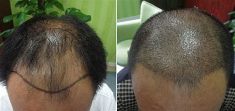 头发稀疏是如何通过头发加密技术得到改善的？_凤凰网健康_凤凰网