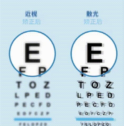 眼科医生是这样区分近视和散光的 - 知乎