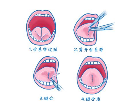 慢性扁桃体炎引起舌底部糜烂硬化图片_有来医生