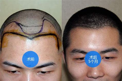 黑龙江植发案例-种植头发-对比效果图-发友网