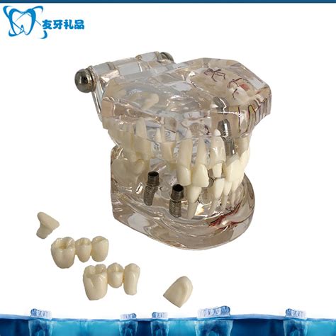 牙齿模型 口腔模型 可拆卸牙齿 牙科模型 成人透明种植模型牙模型-阿里巴巴