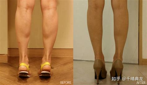 肌肉型和脂肪型的小腿分别要怎么瘦下来？ - 知乎