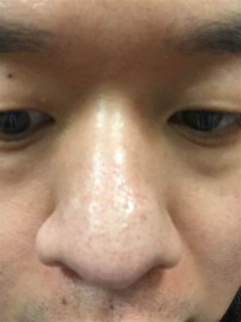 酒糟鼻图片