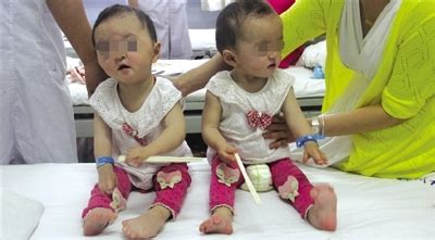 河南：双胞胎女童患怪病 头颅畸形手脚像“鸭蹼”_安徽频道_凤凰网
