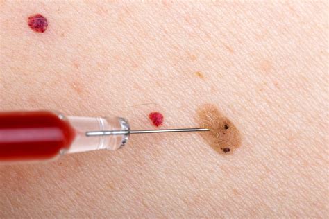 皮肤上长出这4种小红点，虽然不痛不痒，或是疾病的信号