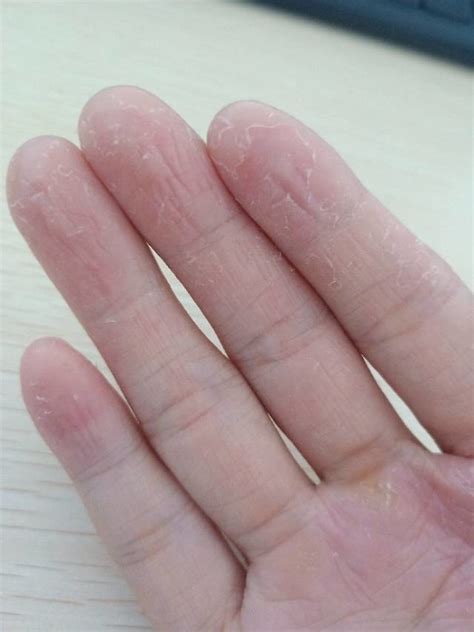 手指关节粗大，是一种病吗？