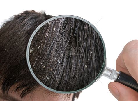 用放大镜检查头发上的头皮屑片高清图片下载-正版图片503021970-摄图网