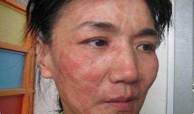 脸部皮肤屏障受损的原因有哪些？如何修复受损的皮肤。 - 知乎