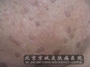 汗孔角化症图片