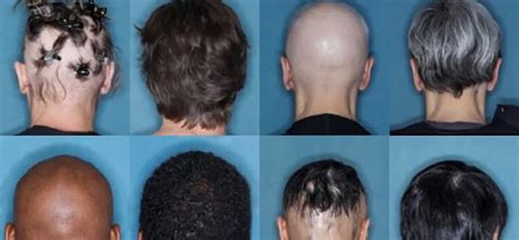 科学家称新疗法可让脱发患者头发再生 – 肽度TIMEDOO