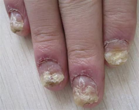 灰指甲的症状和类型-灰指甲症状-复禾健康