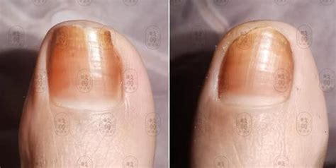 怎么治疗灰指甲最有效的（灰指甲长怎样、会传染？治疗灰指甲的药膏选择？5招预防） | 说明书网