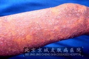 疱疹性皮炎图片