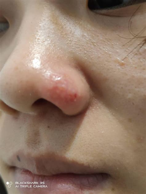 水泡疹脸上,疱疹好了留了疤图片,水泡疹是怎么引起的_大山谷图库