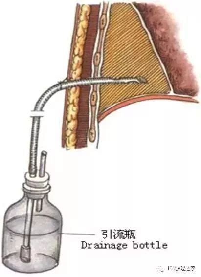 外科常见引流管及PTCD管的护理（韦筱燕）