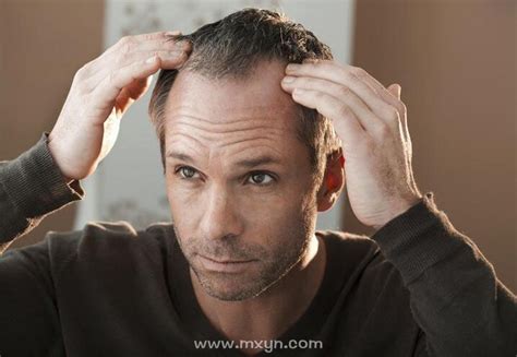 天天长期戴假发会伤害头皮吗或会出现其他问题？ - 知乎