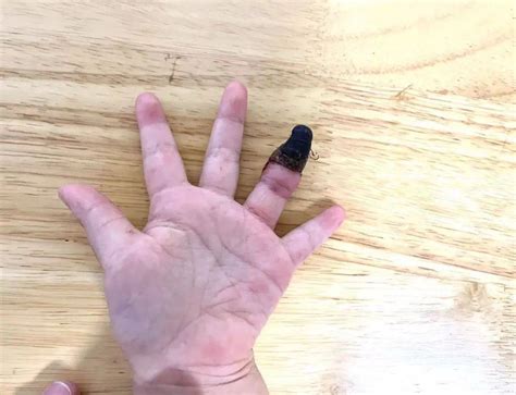 小伤口导致截肢……这个3岁孩子身上到底发生了什么_手指