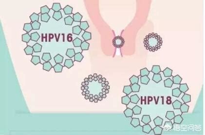 【综述】HPV的致瘤机制及以此预防HPV感染的研究进展_病毒_整合_细胞