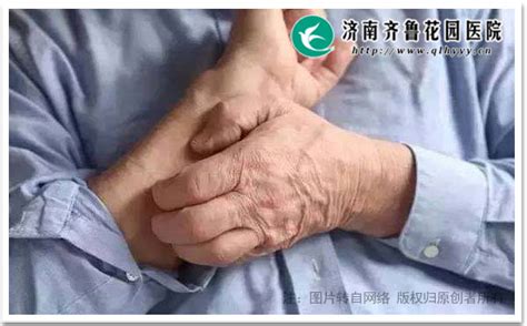 为什么老年人皮肤瘙痒时不能频繁洗澡_济南齐鲁花园医院