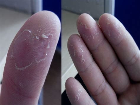 手指脱皮怎么回事？4种常见病因，帮你找到脱皮“真凶”！|手癣|脱皮|手指_新浪新闻