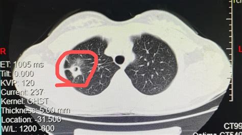 南京江北医院成功治愈难治型肺结核患者-医院汇-丁香园