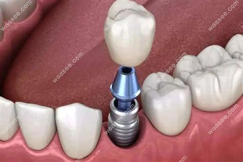 看完种植牙即拔即种优缺点,你会选择即刻种牙还是传统种牙 - 口腔资讯 - 牙齿矫正网