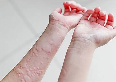 慢性和急性荨麻疹是什么原因引起的图片-中华银屑病网