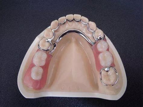 活动义齿哪种较舒服?纯钛活动假牙和吸附性义齿比较舒服,牙齿修复-8682赴韩整形网