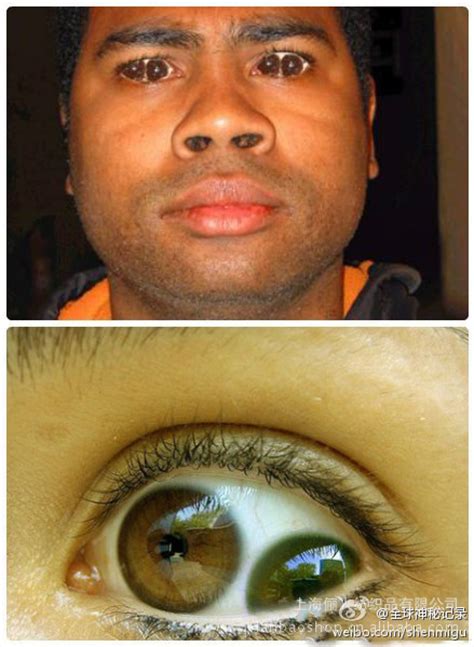 重瞳的症状图片-重瞳图片大全-重瞳-39疾病百科