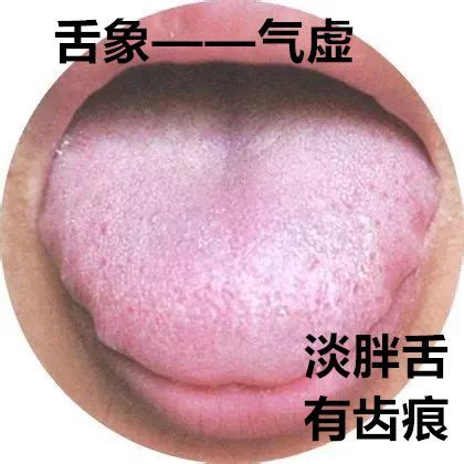 阴虚舌苔图片